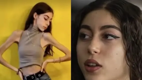 Η Έλλη για τη νευρική ανορεξία