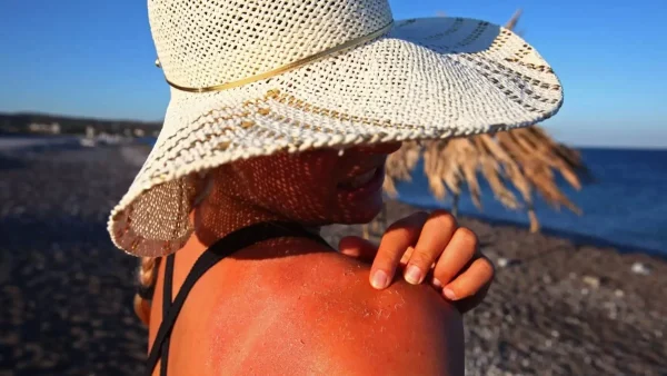 Για να μην ξανά αγοράσεις κρέμα - Ανακούφισε το πόνο του εγκαύματος από την παραλία με μαγειρική σόδα