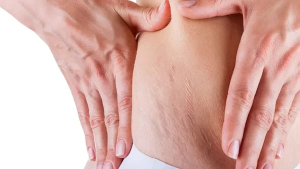 Ραγάδες τέλος σε χρόνο dt - Το μυστικό είναι στην μαγειρική σόδα και στο...