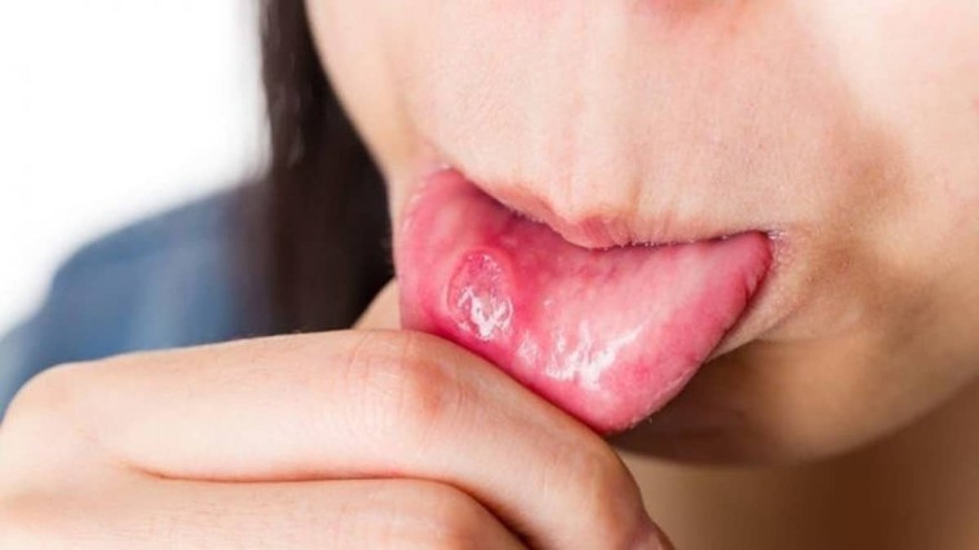 Μαγειρική σόδα άφθες