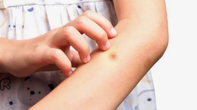 Τέλος τα σημάδια από κουνούπια στο σώμα σου - Ο σούπερ τρόπος με μαγειρική σόδα, σκόρδο και...