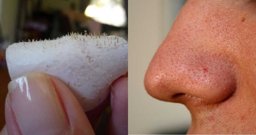 Μαγειρική σόδα μαύρα στίγματα