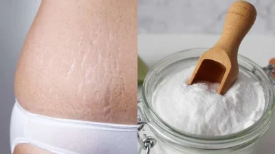 "Εξαφάνισε" στο λεπτό τις ραγάδες μόνο με μαγειρική σόδα και... - Θα σας "λύσει" τα χέρια