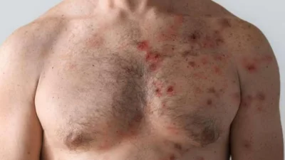 Ευλογιά των πιθήκων: Στα 39 έφτασαν τα κρούσματα σύμφωνα με τον ΕΟΔΥ