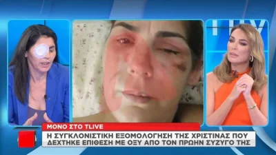 ''Ούρλιαζα από τους πόνους'' - Συγκλονίζει η 49χρονη που δέχτηκε επίθεση με οξύ από τον πρώην σύζυγό της