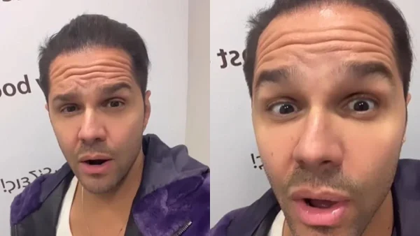 Ακομπλεξάριστος ο Γιώργος Τσαλίκης - Έδειξε το πρόσωπό του πριν και μετά το μπότοξ