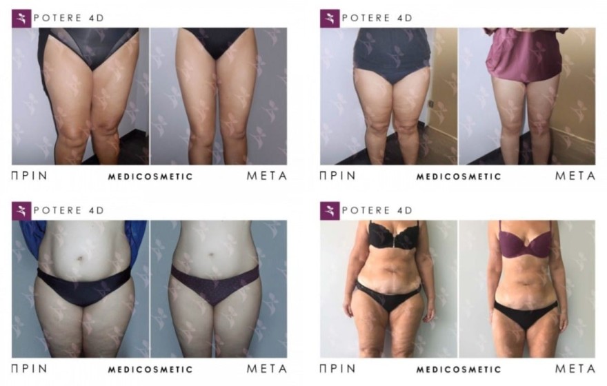 μέθοδος Potere 4D