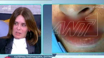 "Λύγισε" η Κατερίνα Πλουμιδάκη: «Το βράδυ νέκρωσα! Όταν είδα ότι έχασα σχεδόν το πρόσωπό μου ήθελα να αυτοκτονήσω»