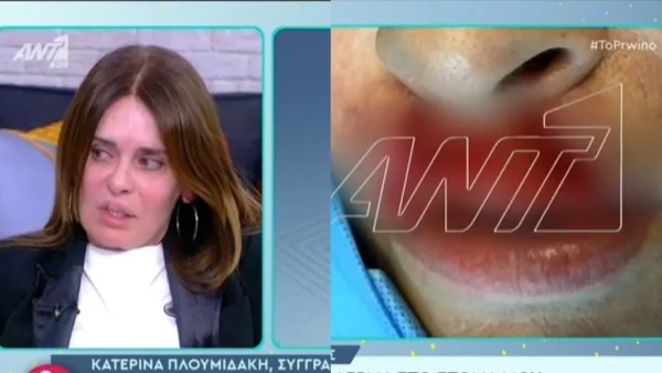 "Λύγισε" η Κατερίνα Πλουμιδάκη: «Το βράδυ νέκρωσα! Όταν είδα ότι έχασα σχεδόν το πρόσωπό μου ήθελα να αυτοκτονήσω»