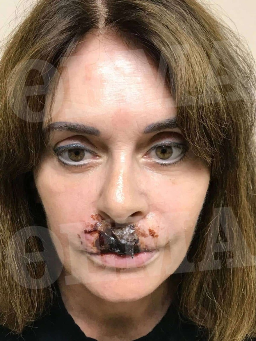 Κατερίνα Πλουμιδάκη πλαστική χείλη