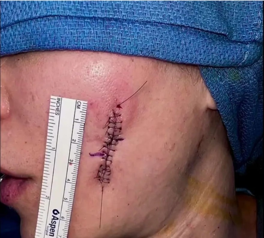 Η φωτογρα΄φια της Κλόε Καρντάσιαν με την τομή από το χειρουργείο