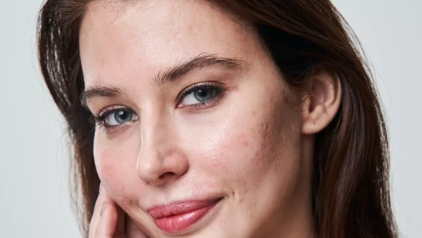 Εξαφανίστε τα σπυράκια από το πρόσωπό σας με 0 ευρώ - Είναι θαυματουργή η ασπράδια αυγών