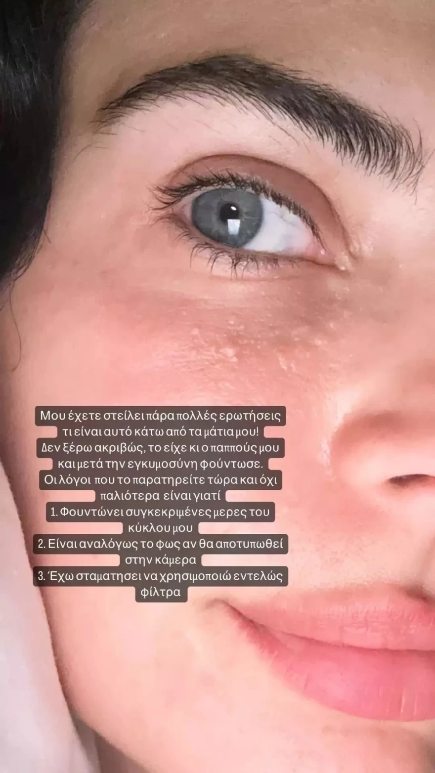 Χριστίνα Μπόμπα πρόβλημα υγείας μάτι