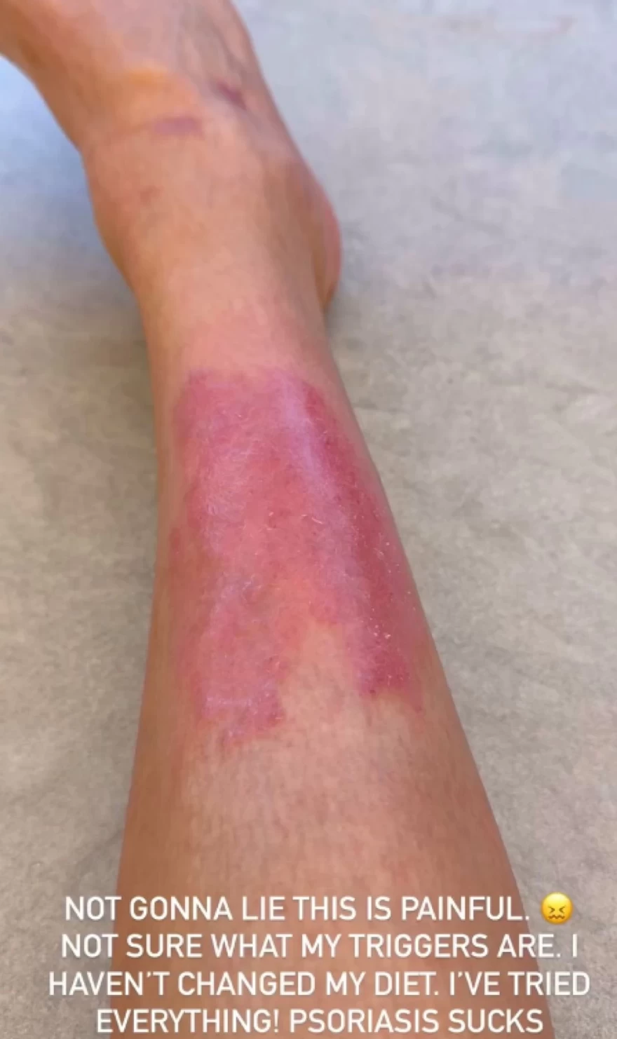 Κιμ Καρντάσιαν - Ψωρίαση