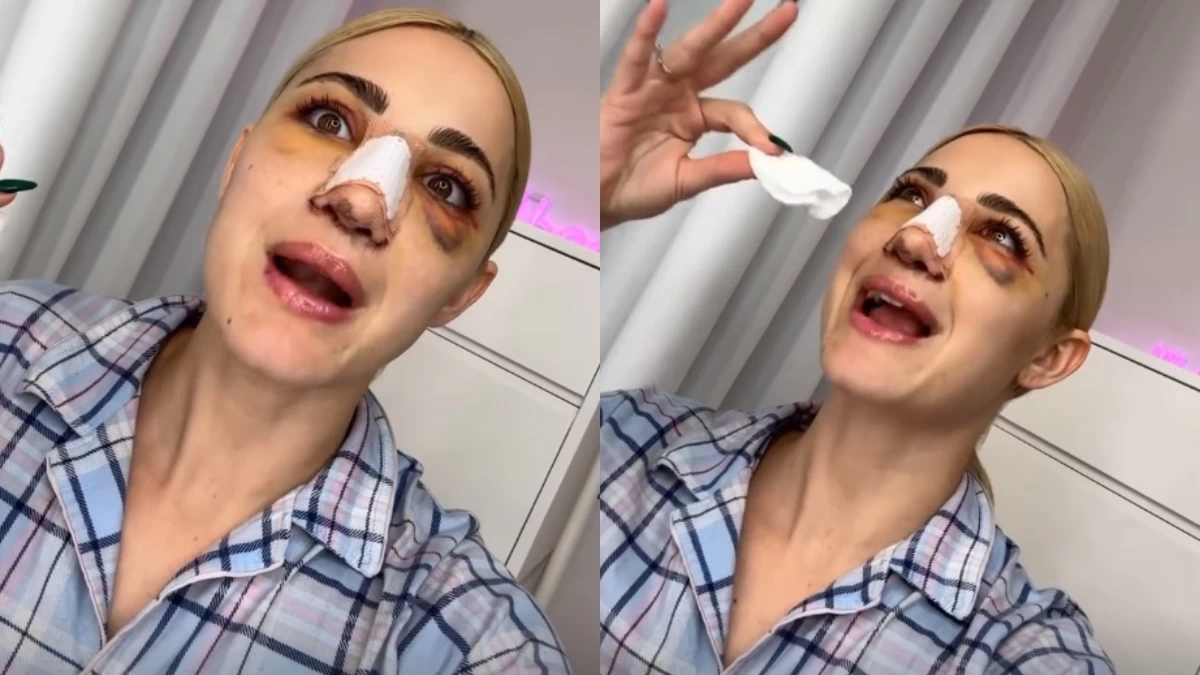 Ιωάννα Τούνη: «Δε μπορούσα να ανοίξω τα μάτια μου...» - Το πρώτο βίντεο μετά την πλαστική επέμβαση στη μύτη της