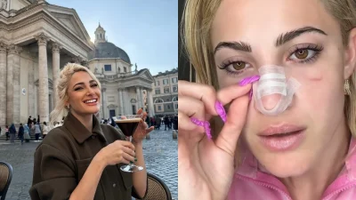 Ιωάννα Τούνη: «Πως έγινε έτσι;» - Έβγαλε τους επιδέσμους από την μύτη! Χαμός με το αποτέλεσμα