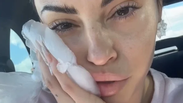 Σοβαρό ατύχημα για τη Δήμητρα Αλεξανδράκη (Βίντεο) - Πρήστηκε το μισό της πρόσωπο: «Λες και έχω κάνει αποτυχημένο υαλουρονικό είμαι»