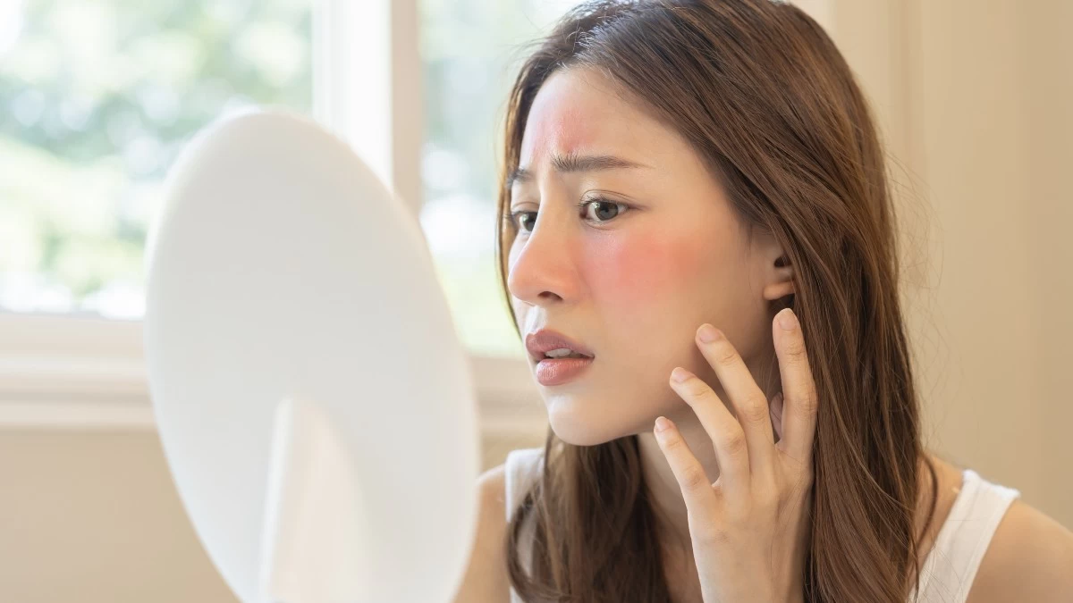 Ροδόχρους ακμή: Με αυτά τα κόλπα θα αντιμετωπίσεις αποτελεσματικά την ερυθρότητα στην επιδερμίδα σου!