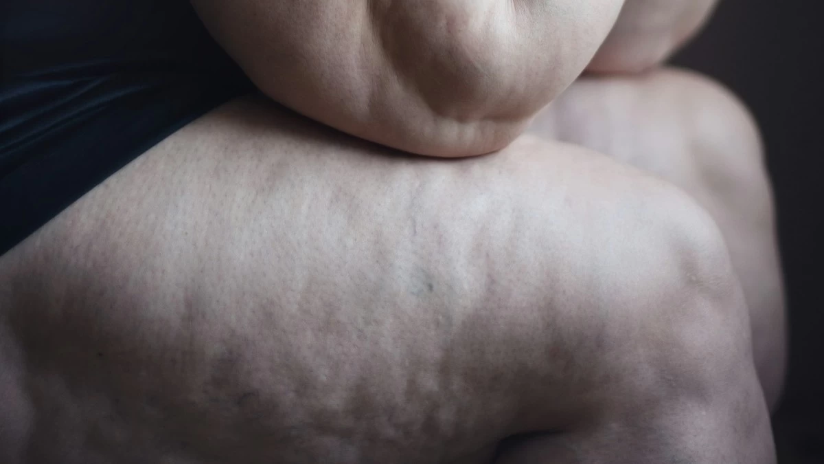 Τέλος η κυτταρίτιδα σε πόδια, χέρια: 3 τρόποι να την αντιμετωπίσεις σε ακραίο βαθμό πριν φτάσει το καλοκαίρι!