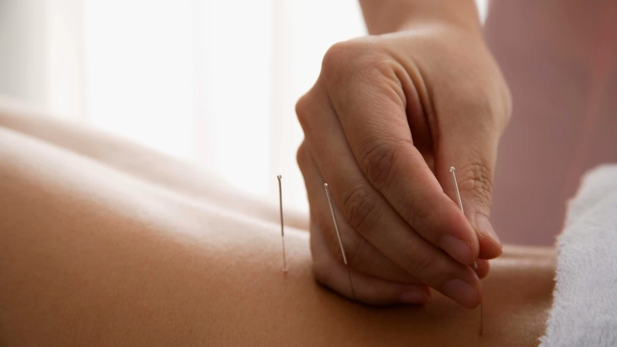 Βελονισμός: Είναι τελικά η εναλλακτική θεραπεία για να χάσεις βάρος;